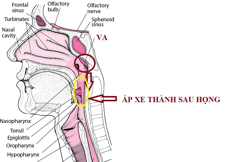 Biến chứng nguy hiểm của viêm VA - áp xe thành sau họng